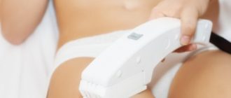 IPL фотоэпиляция