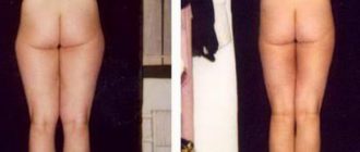 Лазерная липосакция: особенности метода + фото до и после