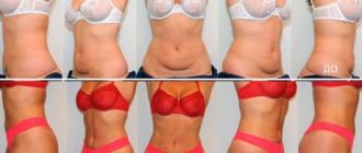 Липосакция в домашних условиях: убираем жир без помощи хирургов