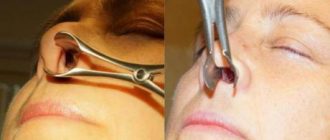 Дефекты носовой перегородки и их коррекция при помощи септопластики