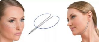 Методика нитевой подтяжки лица