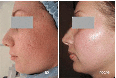 Гликолевый пилинг до и после Гликолевый пилинг до и после