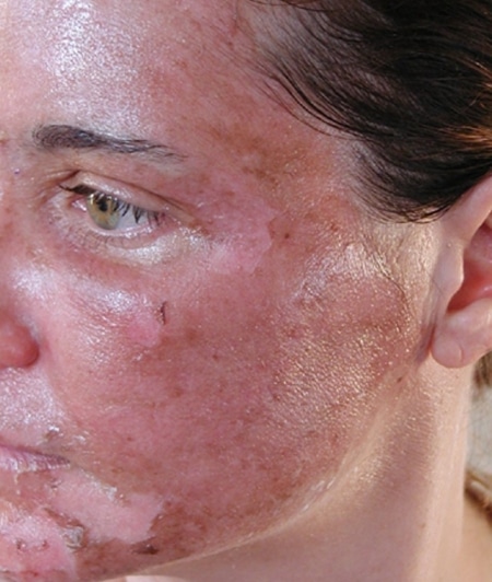 Побочные эффекты химического пилинга Побочные эффекты химического пилинга