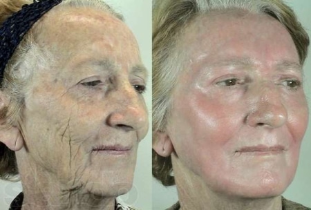 Феноловый пилинг Феноловый пилинг