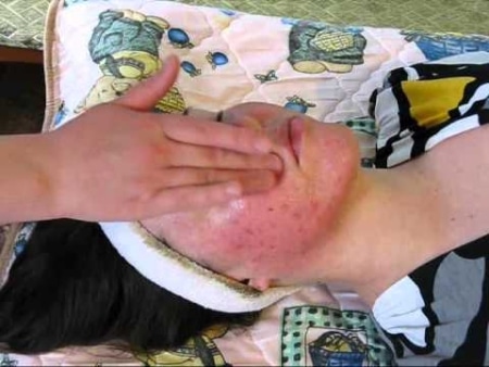 Коралловый пилинг результат Коралловый пилинг результат