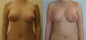 Липофилинг груди Липофилинг молочных желез