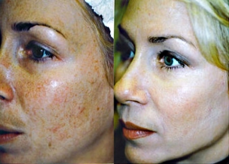 Пилинг джесснера фото Пилинг джесснера фото