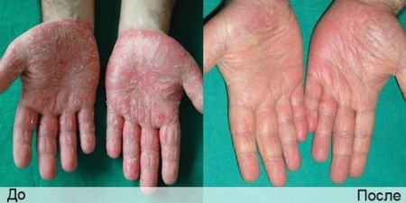 Пилинг рыбками: до и после Пилинг рыбками: до и после