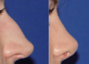 Септопластика носовой перегородки Септопластика