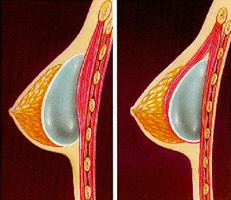 Расположение эндопротезов внутри молочной железы Расположение эндопротезов внутри молочной железы