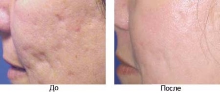 Лазерная шлифовка рубцов до и после Лазерная шлифовка рубцов до и после