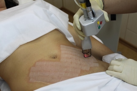 Лазерная шлифовка растяжек Лазерная шлифовка растяжек