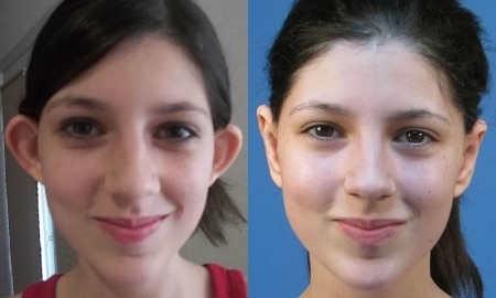 Лопоухость до и после Лопоухость до и после