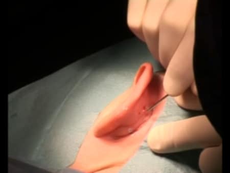 Отопластика Отопластика