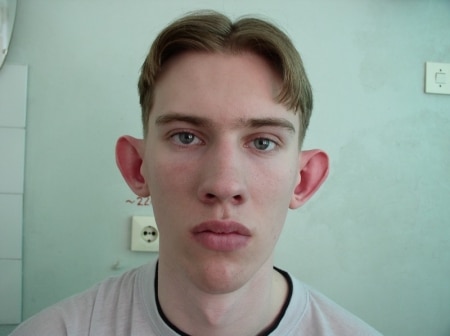 Устранение лопоухости Устранение лопоухости