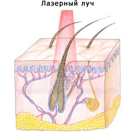 Узконаправленный лазерный луч эпиляция лазером