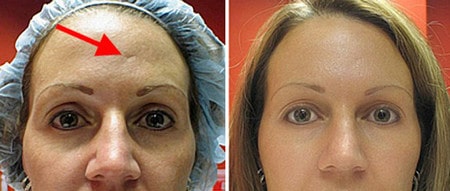 Профессиональное оборудование и высокая квалификация косметолога – залог успешной процедуры результат процедуры