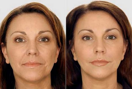 Полную силу диспорт обретет не ранее чем через 14 дней результат