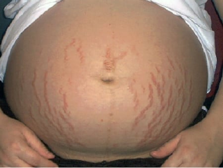 Появлению стрий способствует и большой размер плода природа образования