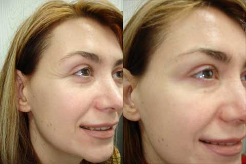 Особенность ботокса доза препарата