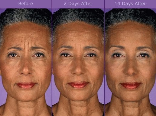 Самому старому пациенту, которому могут ввести ботокс, должно быть не более 65 лет. показания к применению