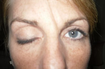 Опущение века может быть побочным эффектом побочный эффект