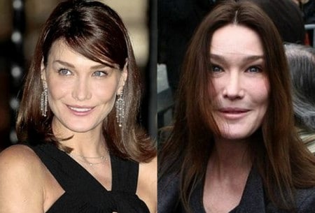 Чрезмерная доза ботокса способна изуродовать лицо доза ботокса