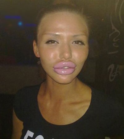 Бывает и такой результат результат ботокса