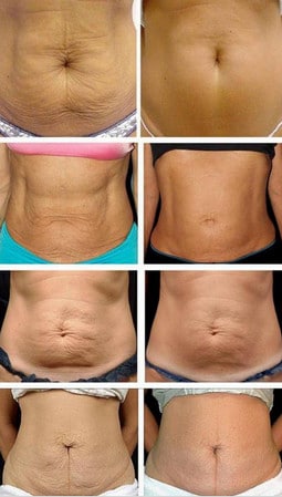 Животы женщин ДО и ПОСЛЕ абдоминопластики результат
