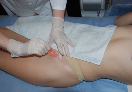 приклеивание воска эпиляция