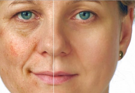 кожа лица после химического пилинга делаем сами