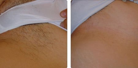 удаление волос методы удаления волос