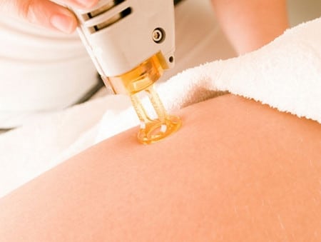 лазерная эпиляция как прводится