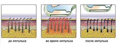 Процедура фотоэпиляции абсолютно безболезненна что происходит