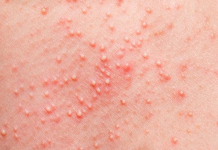 Воспаление фолликула фолликулит