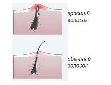 После эпиляции необходимо пользоваться скрабом для тела После эпиляции