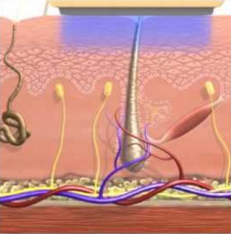 процесс фотоэпиляции