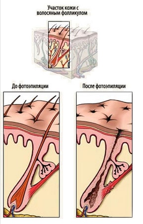 ДО и ПОСЛЕ сеанса фотоэпиляции волосяные луковицы