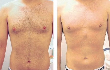 Мужская грудь ДО и ПОСЛЕ фотоэпиляции