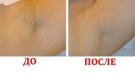 подмышки ДО и ПОСЛЕ нескольких сеансов фотоэпиляции до и после