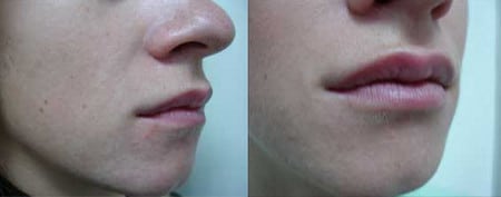 губы становятся более полными, чувственными до и после