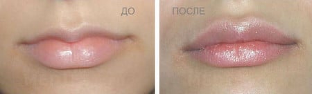 Результат коррекции верхней губы гиалуроновой кислото коррекция губ