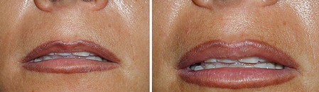 можно вводить женщинам от 17 до 60 лет для любого возраста