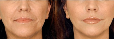 Гиалуроновая кислота корректирует форму губ и убирает мелкие морщины вокруг рта коррекция