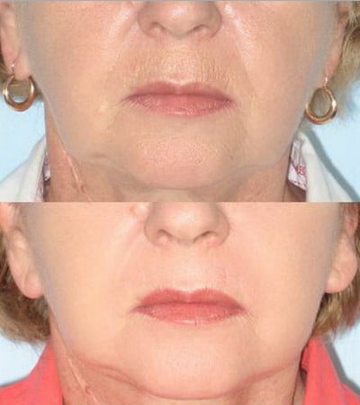 После шлифовки лица мелкие морщины исчезнут