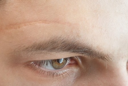 Физиологические рубцы виды рубцов