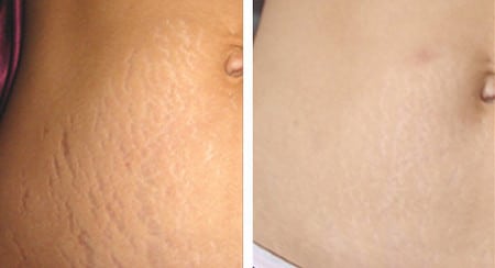 Лазерная шлифовка поможет избавиться от растяжек от растяжек