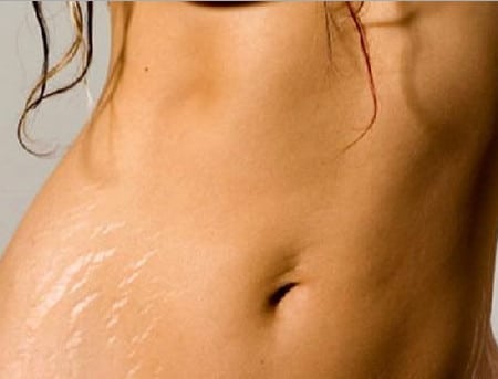 Стрии относятся к атрофическим рубцам растяжки