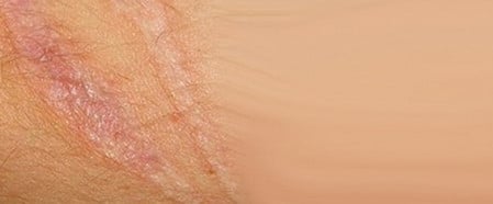 атрофические рубцы какие бывают рубцы