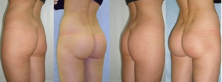 Пластика ягодиц пластика